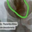 Prefeitura na Paraíba demite médico que vazou raio-X de paciente que inseriu desodorante no ânus